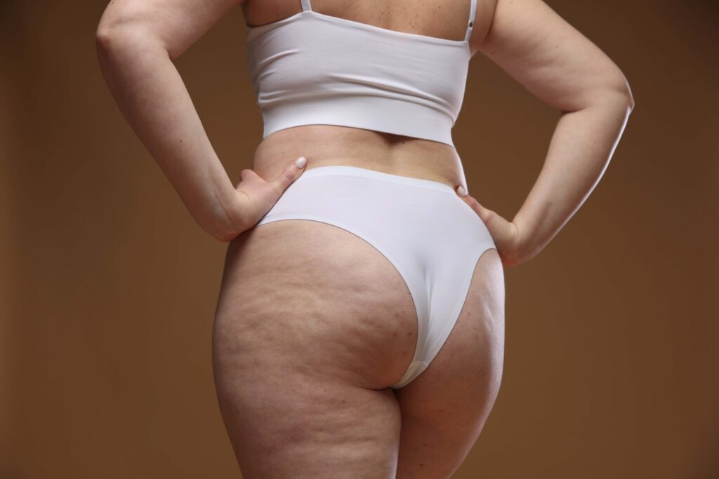 cellulite