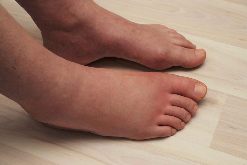 gambe gonfie con liquido