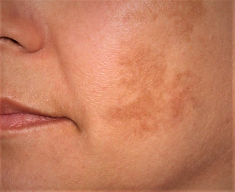 melasma